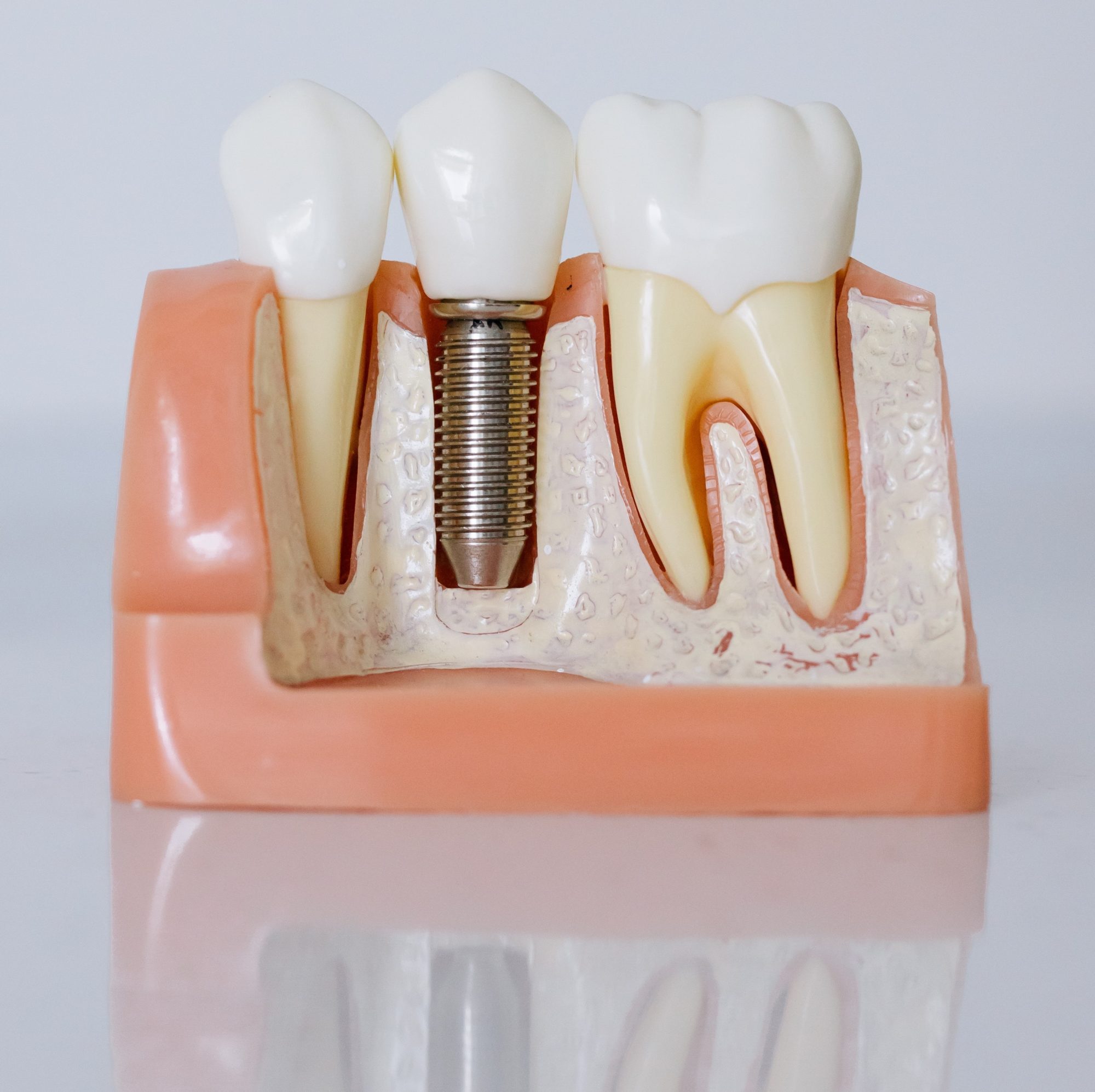 Dantų implantacija