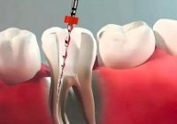 Kada reikalingas endodontinis gydymas?